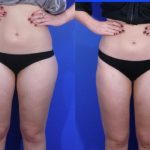 liposuction - liposculpture - before and after image 005 - Academy Face & Body Perth