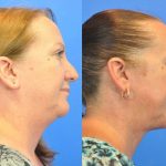 neck lift 001 - liposculpture before and after - side view - real patient