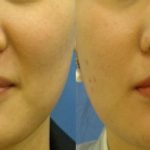 PRP skin rejuvenation - before and after image 03 - Academy Face & Body Perth