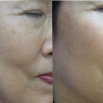 PRP skin rejuvenation - before and after image 04 - Academy Face & Body Perth